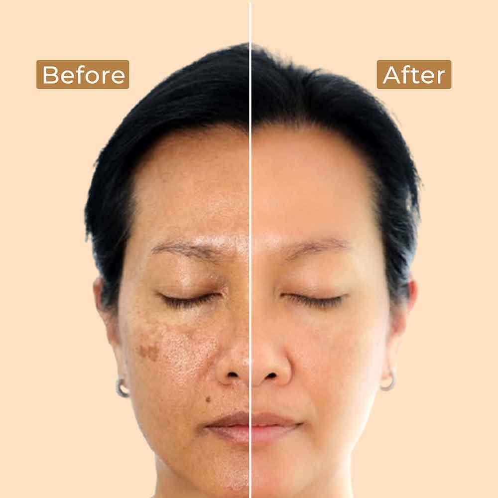 Brightening Depigmentation Gel for Reducing Pigmentation & Dark Spots With Cow Yogurt & Mashobra Honey - Image 4